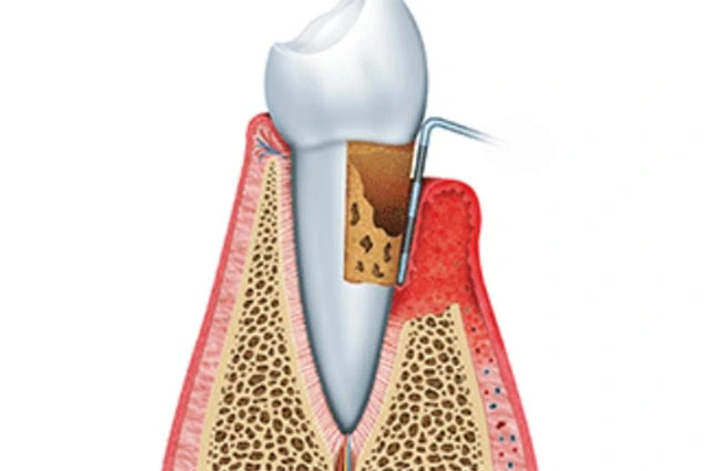 periodontia