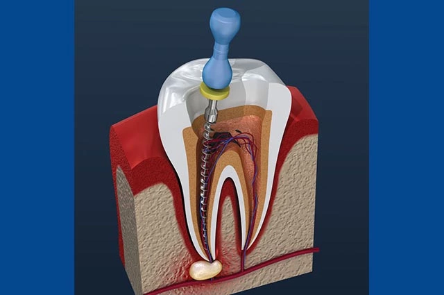 endodontia